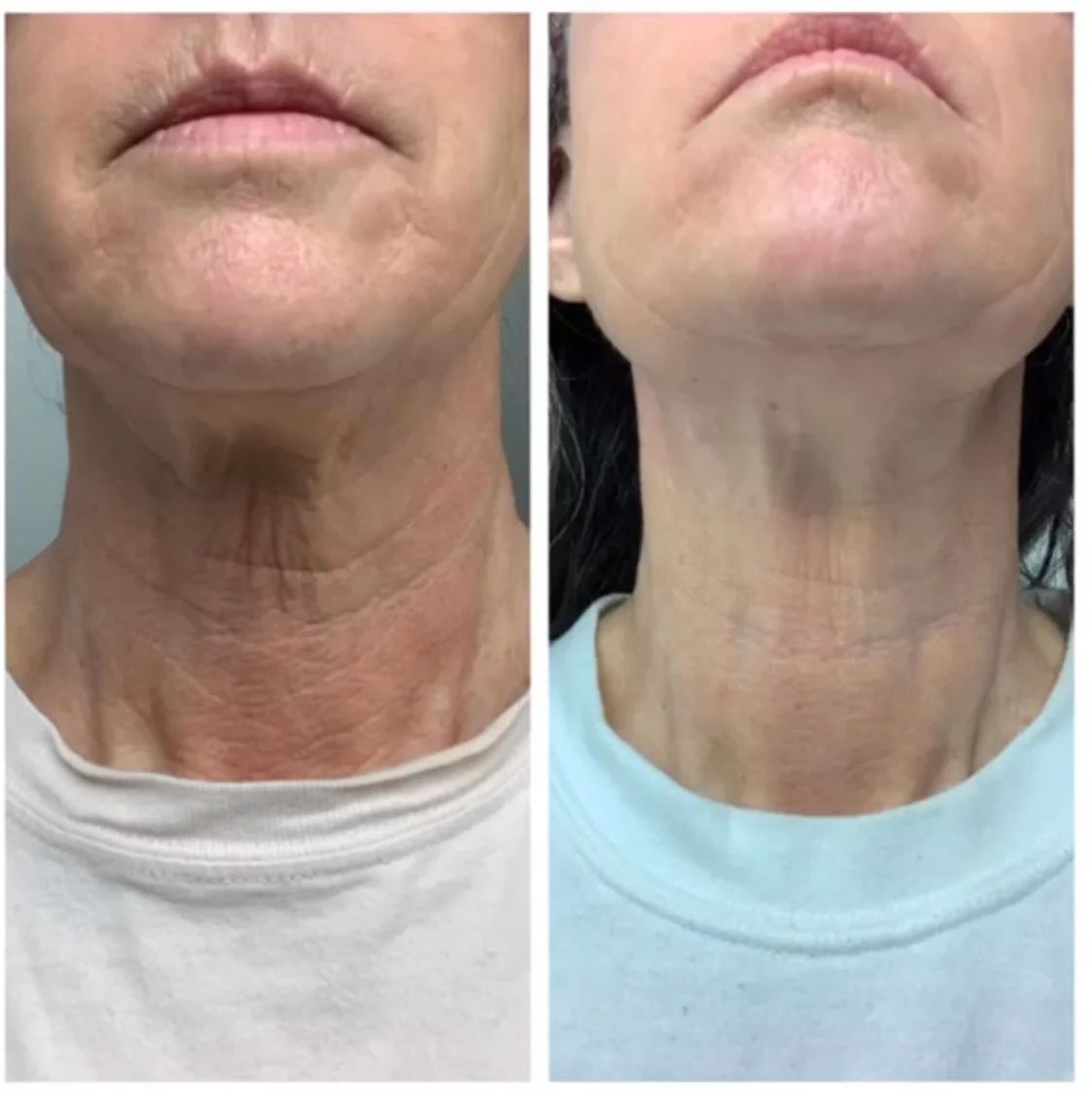 CHIN-UP Peptide Neck and Chin Mask - Image 10