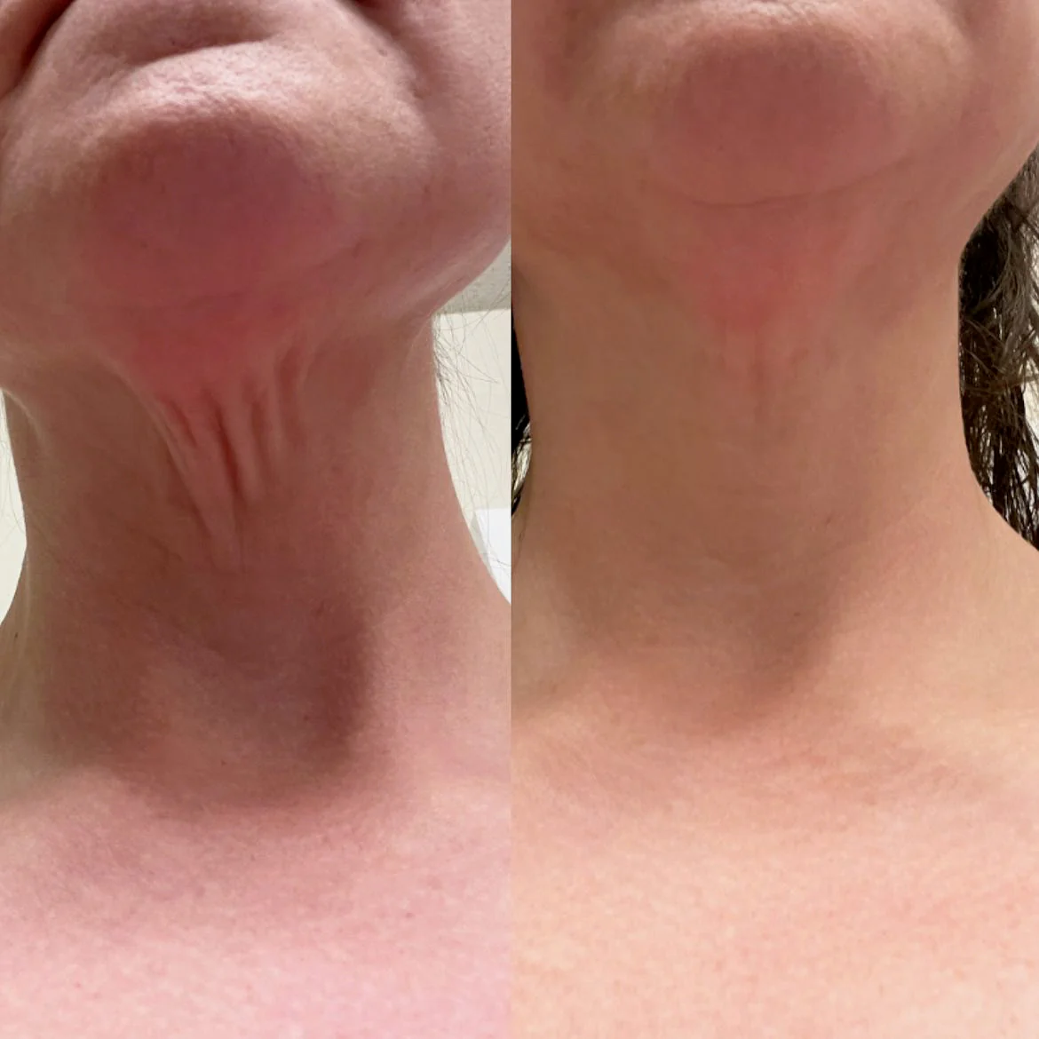 CHIN-UP Peptide Neck and Chin Mask - Image 9