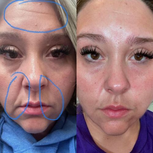 Corners of Eyes & Mouth Facial Patches - Image 6