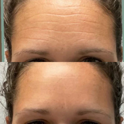 Forehead & Between Eyes Facial Patches - Image 11