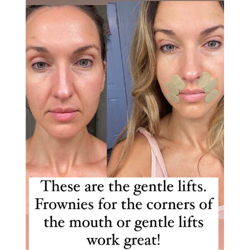 Gentle Lifts for Lip Lines - Image 8
