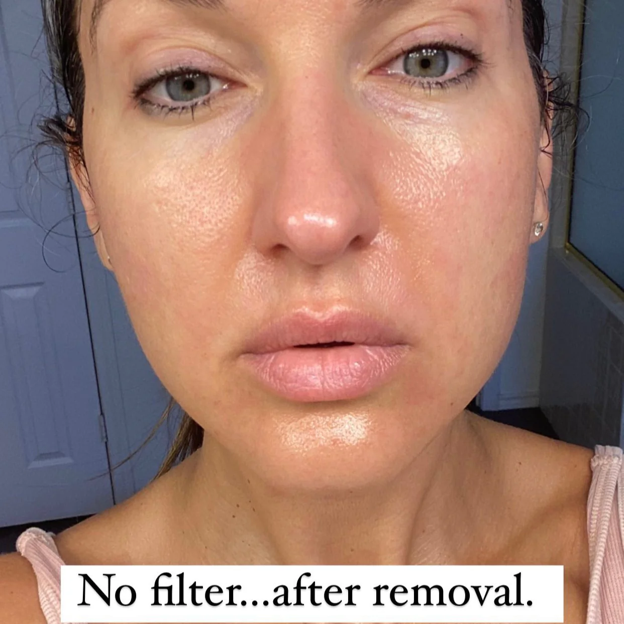 Gentle Lifts for Lip Lines - Image 9